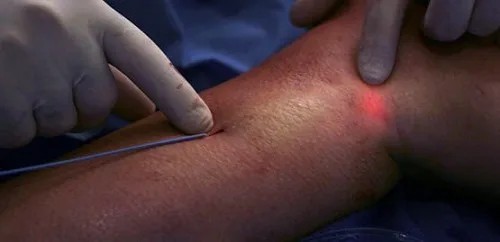 Liệu pháp Laser nội tĩnh mạch