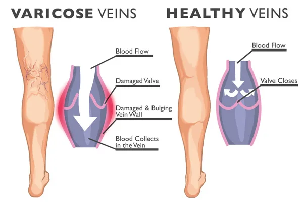 Varicoses veins and healthy veins