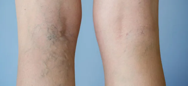Varicose veins