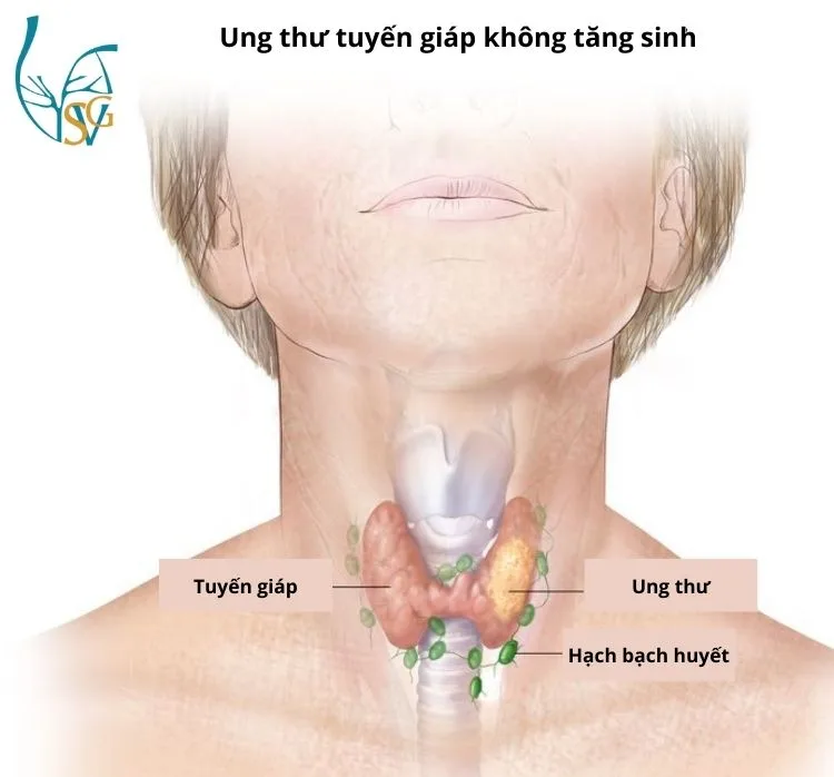 Ung thư tuyến giáp không tăng sinh