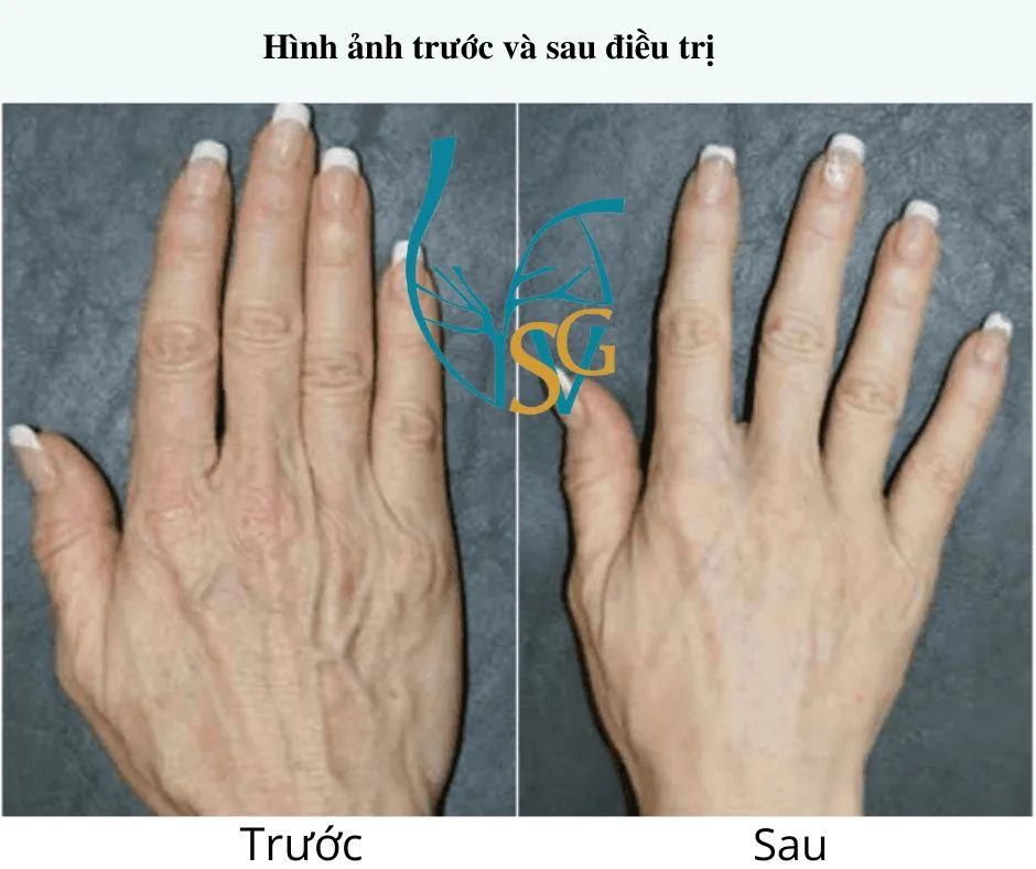 Ung thư tuyến giáp không tăng sinh