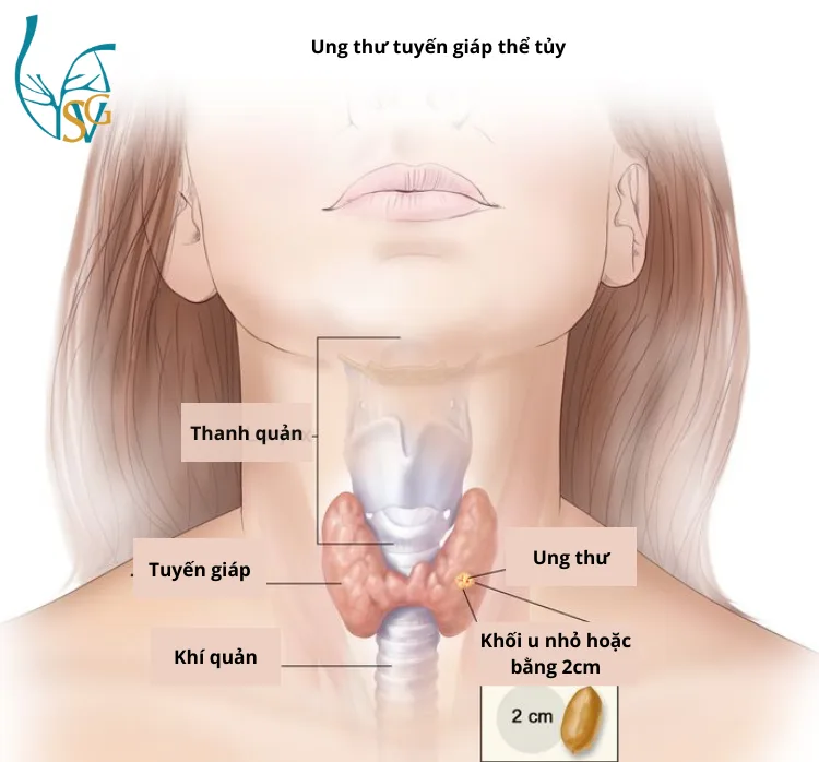 Ảnh minh họa ung thư tuyến giáp thể tủy