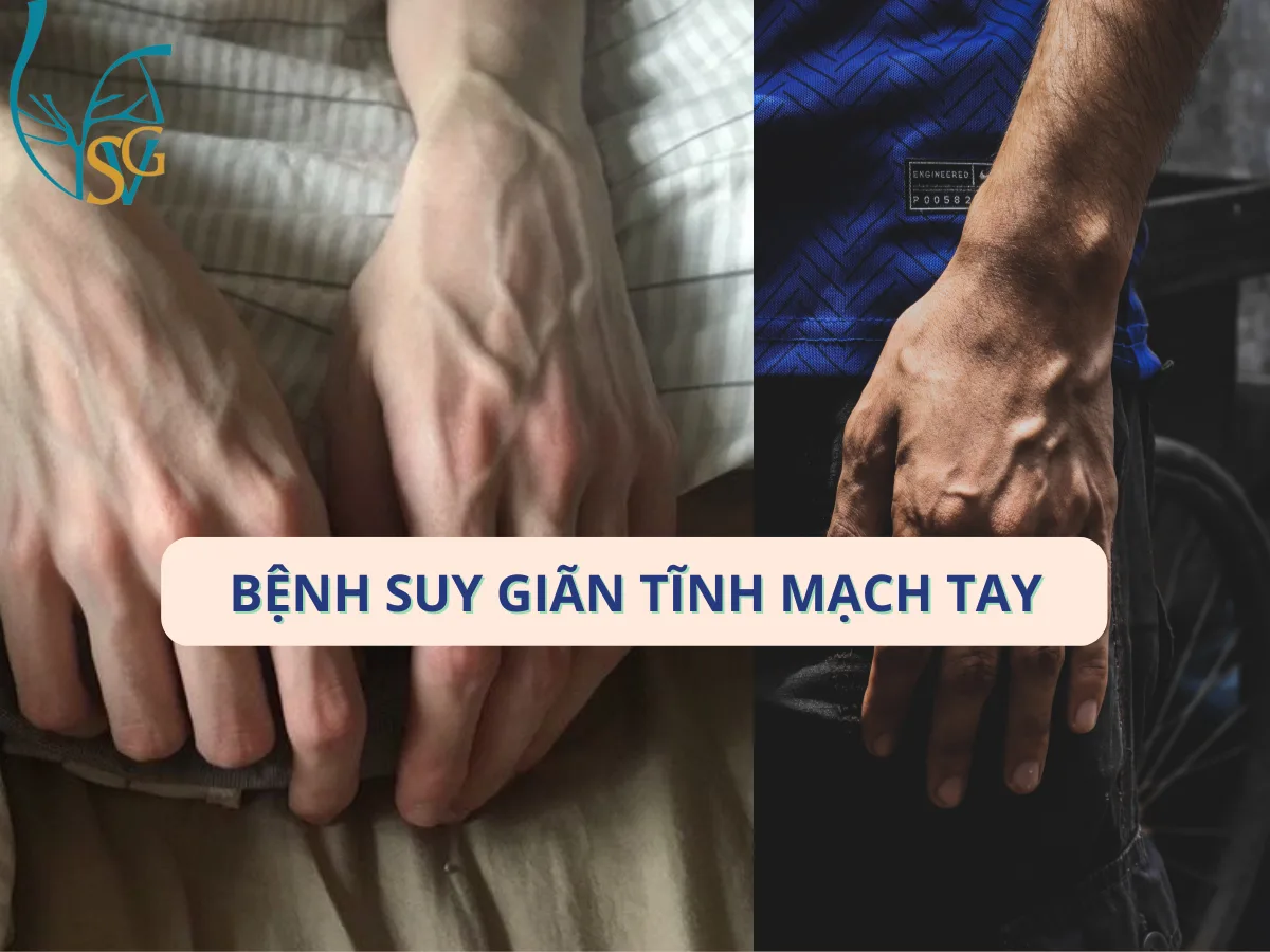Giãn tĩnh mạch tay là gì? Nguyên nhân và cách điều trị