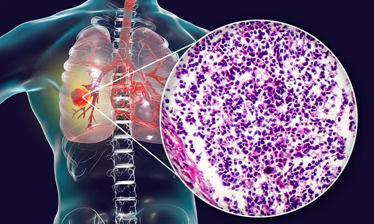 Small-cell-lung-cancer