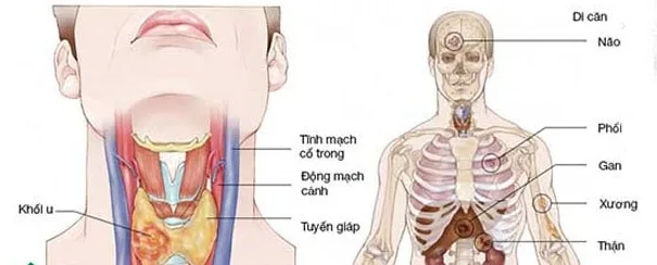Ảnh minh họa về ung thư tuyến giáp di căn