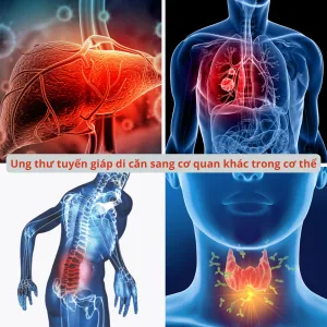 Ung thư tuyến giáp di căn đến các bộ phận