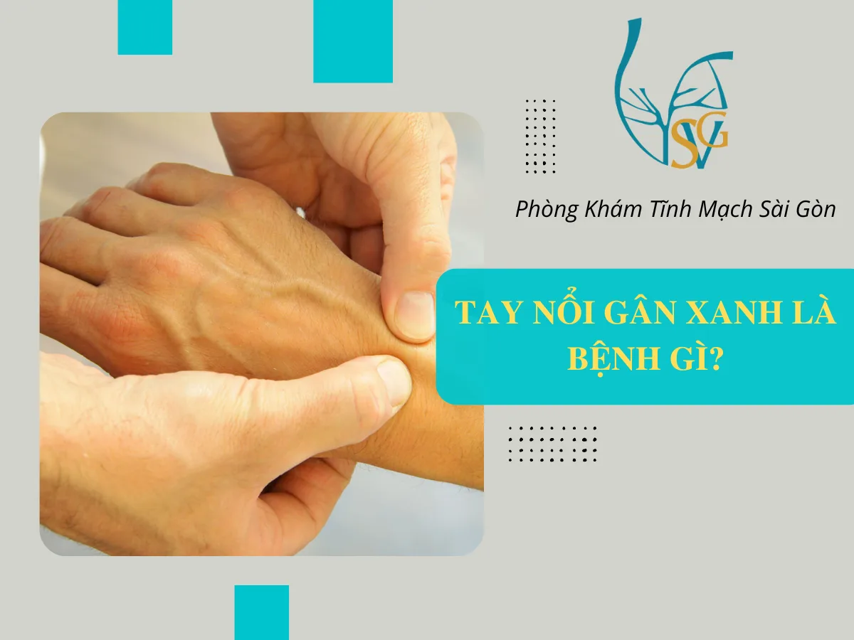 Bàn tay nổi gân xanh là bị gì-Có nguy hiểm không?