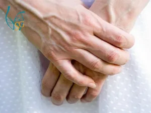 Giãn tĩnh mạch tay nguyên nhân do đâu