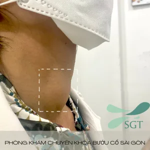 Trường hợp bệnh nhân bị bướu cổ 