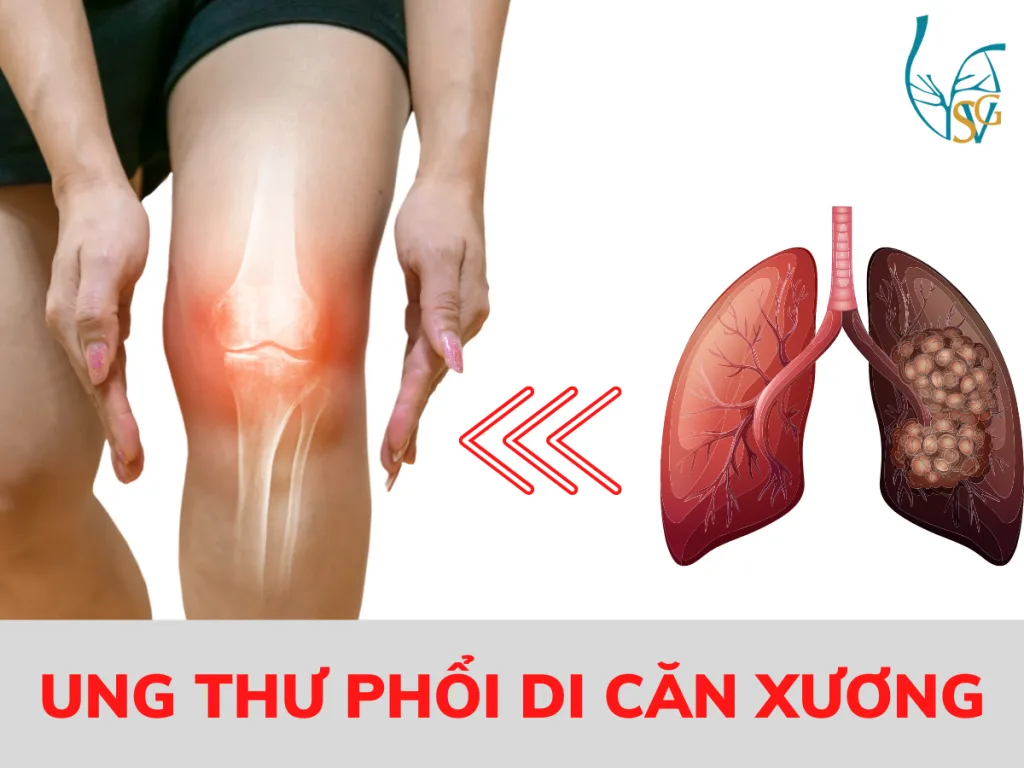 UNG THƯ PHỔI DI CĂN XƯƠNG