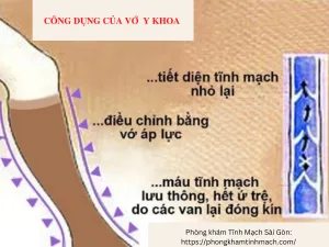 Lợi ích khi mang vớ y khoa cho người bị giãn tĩnh mạch
