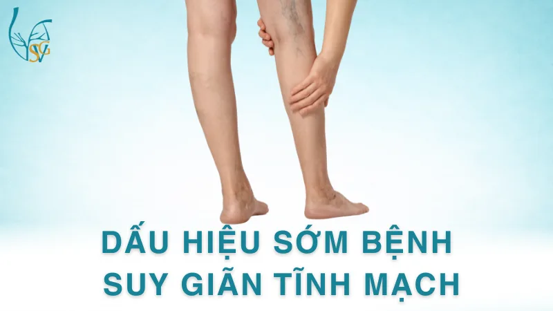Dấu hiệu sớm Bệnh suy giãn tĩnh mạch